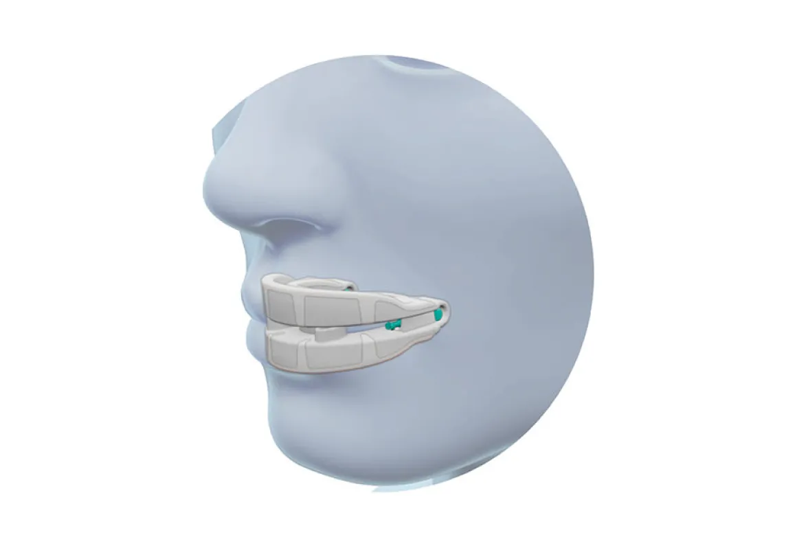 Anti Snoring Mouthpiece Device