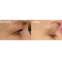 Full Face Professional Light Therapy System