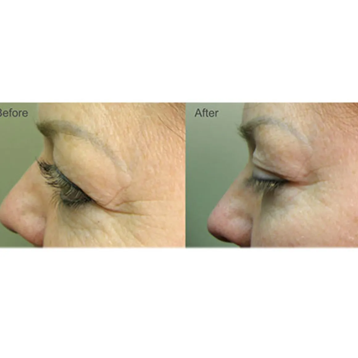 Full Face Professional Light Therapy System