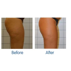 LED Cellulite Reducing Device