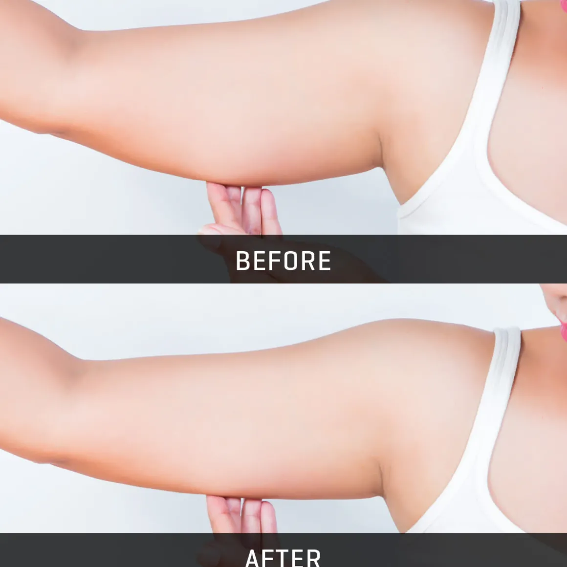 Underarm Toner