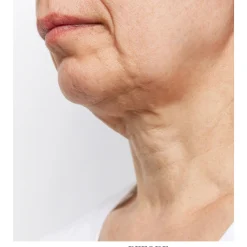 Wrinkle Reducing Neck Therapy Device
