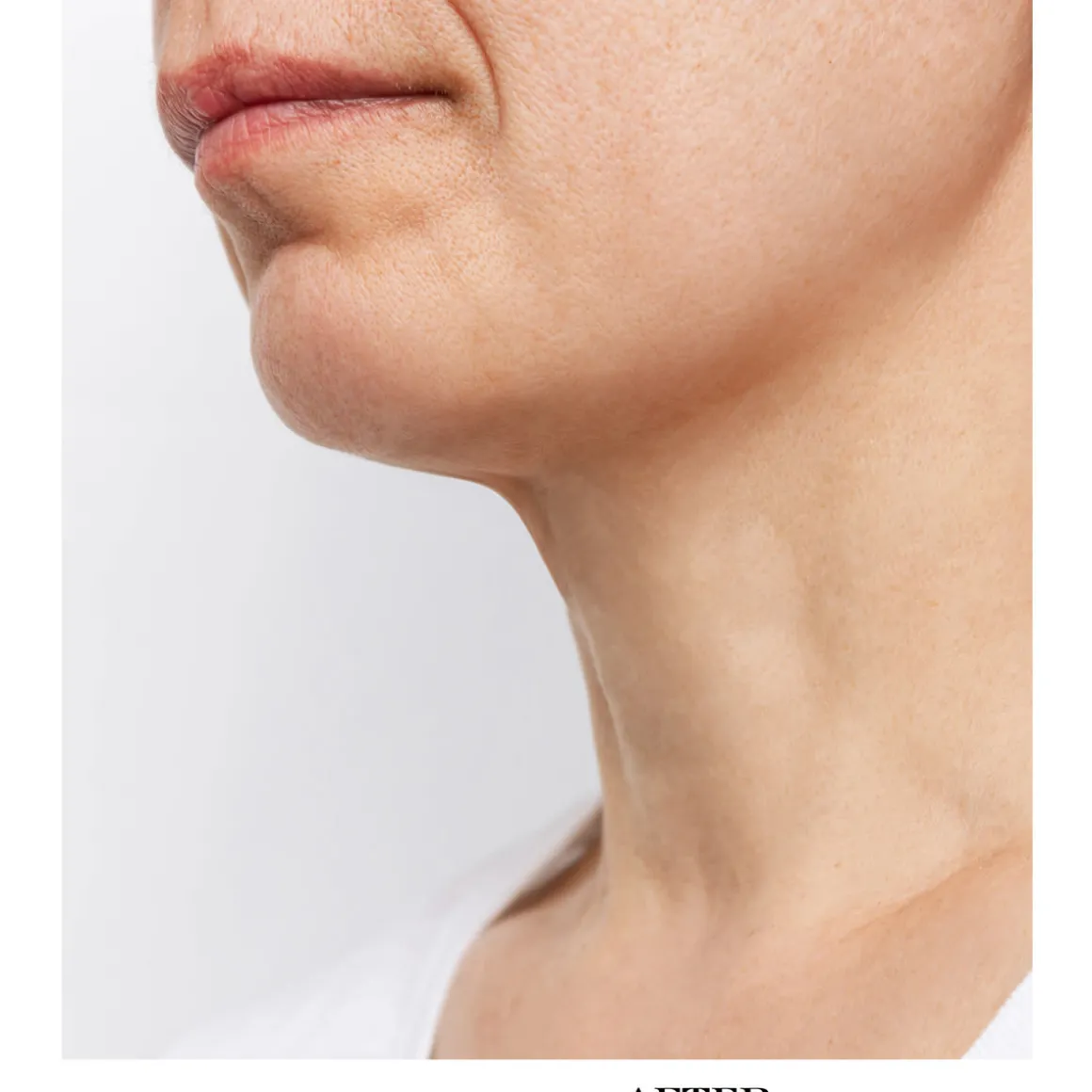 Wrinkle Reducing Neck Therapy Device