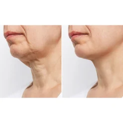 Wrinkle Reducing Neck Therapy Device