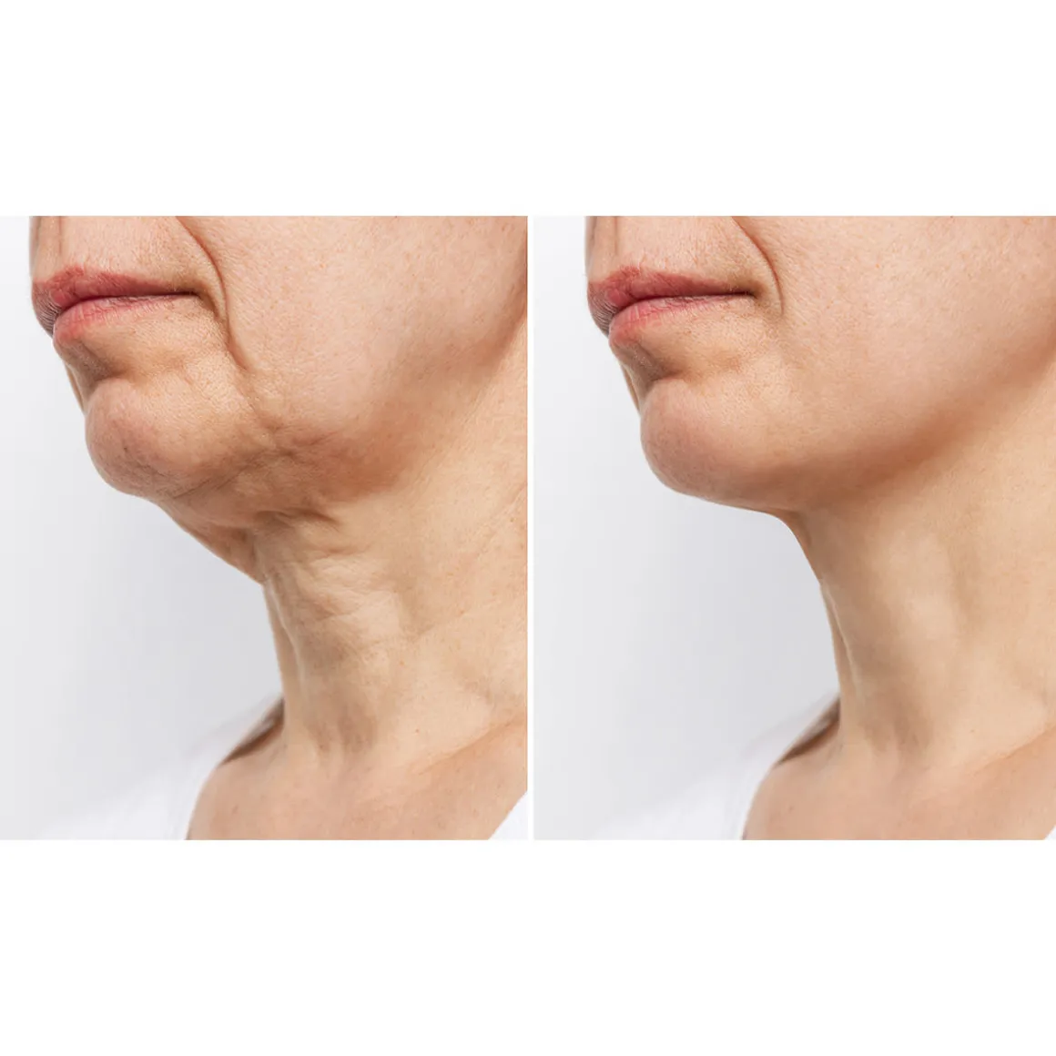 Wrinkle Reducing Neck Therapy Device